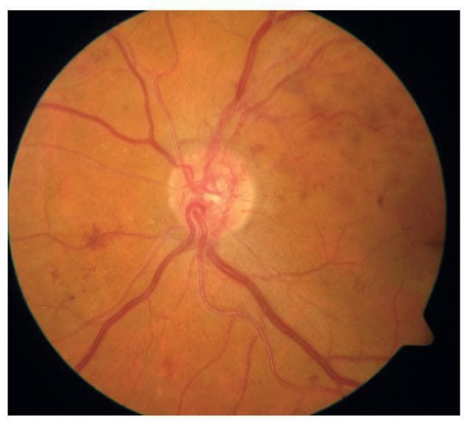 This color fundus photograph displays the posterior pole of a human eye with hallmarks of Proliferative Diabetic Retinopathy (PDR). The optic disc is centrally located and serves as the origin for the major retinal vascular arcades. A key diagnostic feature is the presence of neovascularization of the disc (NVD), characterized by a fine, tangled, and tortuous network of abnormal new blood vessels proliferating on and immediately adjacent to the optic nerve head. The surrounding retina shows multi-focal pathology, including scattered dot-and-blot intraretinal hemorrhages and smaller microaneurysms, particularly prominent in the temporal and nasal quadrants. Faint, yellowish deposits suggestive of hard exudates are visible in the peripapillary region. The vascular caliber appears irregular, and the overall fundus background exhibits a slightly hazy appearance, possibly due to vitreous changes or early preretinal hemorrhage. This image serves as a clinical example of advanced diabetic microvascular disease requiring urgent ophthalmic intervention.