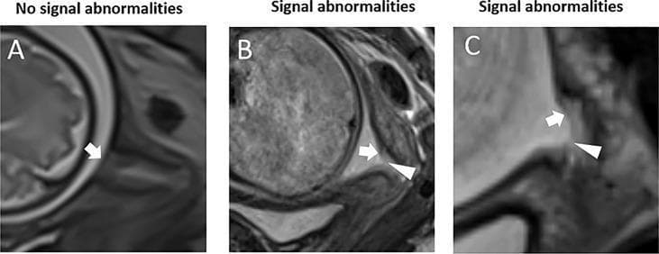 This diagnostic image consists of three sagittal T2-weighted magnetic resonance imaging (MRI) scans focusing on the uterine cervix and fetal membranes (FM) during the second and third trimesters of pregnancy. The series serves as a comparison chart for identifying structural integrity and signal abnormalities in the fetal membranes. Panel A (32 weeks) illustrates a normal fetal membrane, appearing as a continuous, low-to-intermediate signal intensity line (white arrow) with uniform thickness. Panel B (32 weeks) demonstrates a prolapsed fetal membrane with a signal abnormality characterized by a partial defect (white arrowhead) or discontinuity in the membrane. Panel C (28 weeks) shows another prolapsed membrane exhibiting local thinning and increased T2 signal intensity (white arrowhead), suggesting focal edema or structural weakening. These images highlight the clinical utility of MRI in detecting markers of preterm premature rupture of membranes (PPROM) and cervical insufficiency by evaluating the relationship between the fetal membranes and the internal cervical os.