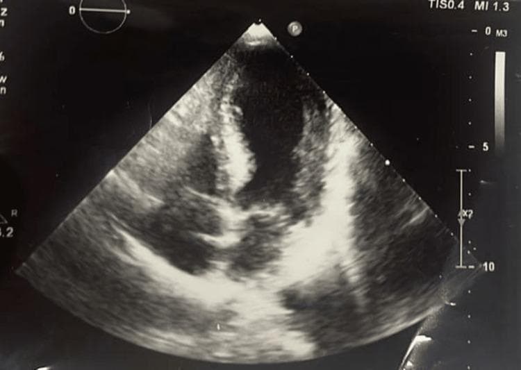 This diagnostic image is a transthoracic echocardiogram in an apical four-chamber view, demonstrating the hallmark signs of Takotsubo cardiomyopathy (stress-induced cardiomyopathy). The visualization shows significant left ventricular apical ballooning, where the distal portion of the left ventricle appears dilated and rounded compared to the hypercontractile basal segments. The myocardium exhibits varying echogenicity, with relatively hypoechoic blood-filled chambers and more echogenic myocardial walls. The apical region demonstrates dyskinesia or akinesia, characterized by a lack of systolic wall thickening and outward expansion during the cardiac cycle. This morphological pattern creates a shape resembling a Japanese octopus trap (takotsubo), which is a key educational feature for identifying this syndrome. Clinical significance includes severe systolic dysfunction, often associated with ST-elevation on ECG despite clear coronary arteries. The image serves as a classic educational example of regional wall motion abnormalities that do not follow a single coronary artery distribution.
