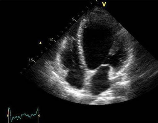 This diagnostic ultrasound image shows a grayscale transthoracic echocardiogram (TTE) in the apical four-chamber (A4C) view. The image demonstrates a significantly dilated and globular left ventricle (LV), which has lost its normal elliptical shape, indicative of dilated cardiomyopathy. All four cardiac chambers are visible: the left ventricle, right ventricle, left atrium, and right atrium. The left ventricle appears disproportionately large compared to the right-sided chambers, and there is evidence of global hypokinesia suggested by the myocardial wall appearance. The interventricular septum and mitral valve apparatus are visible, though the valve leaflets appear stretched due to ventricular remodeling. This clinical finding is characteristic of severe systolic dysfunction, such as peripartum cardiomyopathy, consistent with a reduced ejection fraction. A synchronized ECG tracing is visible in the lower-left corner for timing the cardiac cycle during the imaging study.