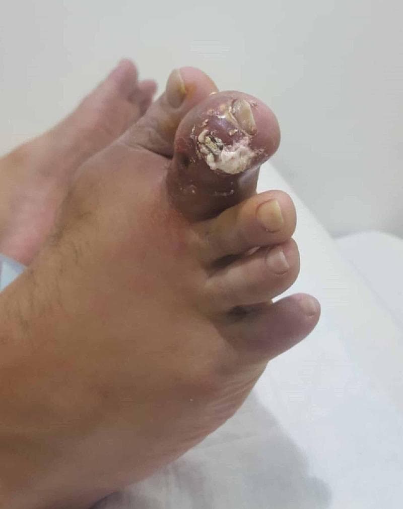 Clinical photograph of a human foot, focusing on the second toe, which exhibits severe gouty tophus formation. The distal portion of the toe is significantly enlarged with tense, erythematous skin, indicating acute inflammation. At the distal interphalangeal joint level, there is a visible rupture of the skin with the extrusion of chalky, white, toothpaste-like material characteristic of monosodium urate crystals. The surrounding soft tissue is edematous, and the nail appears dystrophic and partially elevated due to the underlying pressure of the tophaceous deposit. This image serves as a classic clinical representation of chronic tophaceous gout with an acute flare and ulceration. The condition demonstrates the typical presentation of urate crystal deposition in peripheral small joints, resulting in significant joint deformity and soft tissue involvement.
