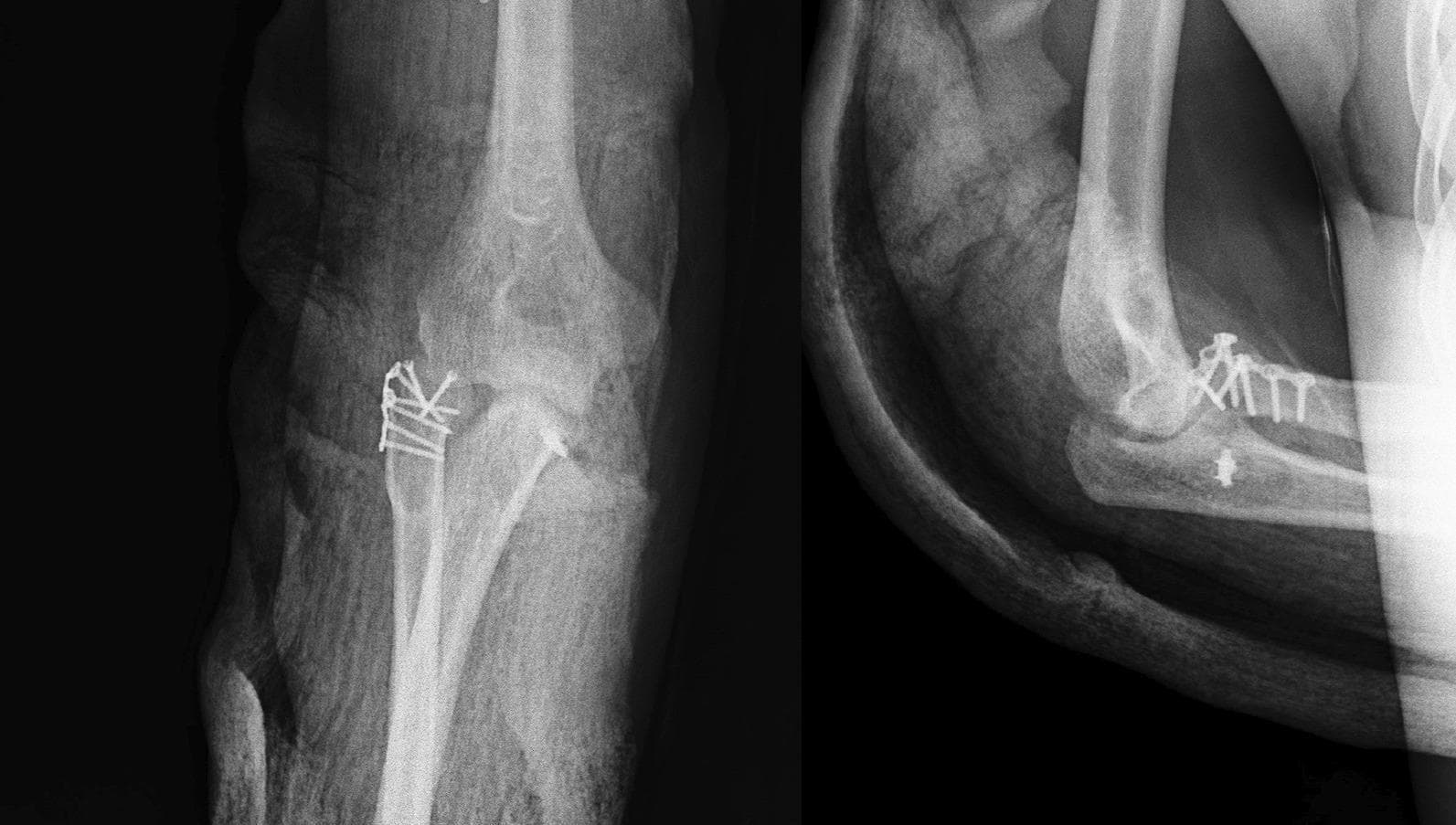 Postoperative X-ray of the right elbow in anteroposterior (AP) and lateral views. The images demonstrate the status after internal fixation of a radial head fracture. Open reduction and internal fixation (ORIF) hardware is clearly visible, consisting of a low-profile mini plate and multiple cortical screws spanning the proximal radius. In the AP view, the hardware is positioned along the lateral aspect of the radial head and neck, maintaining stable reduction of the fracture fragments. The ulnohumeral and radiocapitellar joints appear congruent, with no evidence of subluxation or dislocation. The coronoid process and olecranon are intact. There is a single screw or suture anchor visible in the region of the coronoid/proximal ulna on the lateral view, suggesting possible repair of a concomitant coronoid fracture. Soft tissue swelling is present, consistent with the immediate postoperative period. The radiographic findings confirm appropriate alignment and stabilization of the complex elbow injury, typically classified as a Mason type 4 radial head fracture with associated instability.