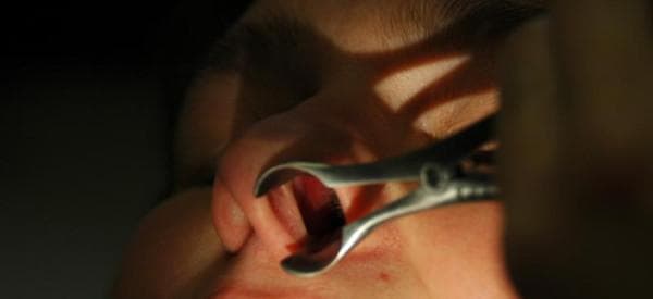 This clinical photograph demonstrates an anterior rhinoscopy procedure, a primary diagnostic technique in otorhinolaryngology. A metallic Killian or Thudichum-style nasal speculum is inserted into the left nostril (vestibulum nasi) and dilated to provide a clear view of the internal nasal structures. The image shows the application of a targeted light source, illuminating the anterior part of the nasal cavity. Visible landmarks include the nasal ala, the columella, and the internal mucosal lining. The procedure is used to evaluate the nasal septum for deviations, inspect the inferior turbinates for hypertrophy or inflammation, and assess the nasal mucosa for signs of allergic rhinitis, such as pallor, edema, or discharge. This procedural image is an essential teaching tool for medical students and residents learning the fundamental steps of a physical examination of the upper respiratory tract and the clinical workup for sino-nasal symptoms.