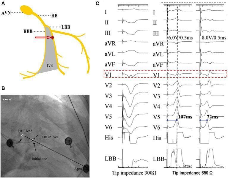 This composite educational image illustrates the localization and electrophysiological characteristics of left bundle branch pacing (LBBP). Panel A is an anatomical diagram showing the atrioventricular node (AVN), His bundle (HB), and the branching into the right bundle branch (RBB) and left bundle branch (LBB) along the interventricular septum (IVS). Panel B is a fluoroscopic image in the right anterior oblique (RAO) 30° view, demonstrating lead placement for His-bundle pacing (HBP) and LBBP relative to the cardiac apex. Panel C displays 12-lead ECG tracings and intracardiac electrograms demonstrating the progression of LBB capture. Key features include the transformation of lead V1 morphology from a 'W' pattern with a nadir notch (unipolar tip pacing at 300 Ω) to an R wave as the lead is advanced deeper into the septum (650 Ω). The rightmost tracings show the shift to a right bundle branch block (RBBB) pattern when output is increased from 6.0 V to 8.0 V, with a corresponding shortening of the peak left ventricular activation time (pLVAT) from 107 ms to 72 ms, indicating definitive LBB capture.