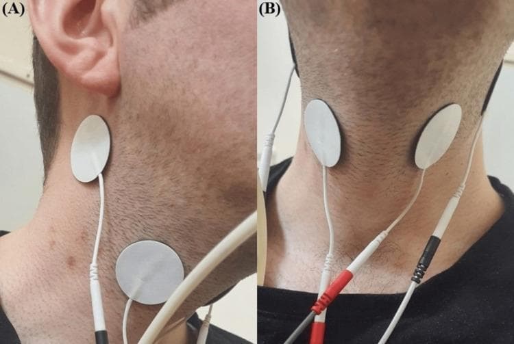 Clinical photograph in two views (A and B) demonstrating the electrode placement for Interferential Current (IFC) therapy, a neuromuscular electrical stimulation technique used in dysphagia rehabilitation. Image (A) provides a lateral (side) view of the neck, showing two circular, white surface electrodes adhered to the skin. One is positioned in the submental region near the angle of the mandible, and the second is placed inferiorly along the anterior border of the sternocleidomastoid muscle, targeting the superior laryngeal nerve pathway. Image (B) shows an anterior (front) view, illustrating the symmetrical placement of the electrodes on both sides of the laryngeal prominence. Thin, white lead wires with color-coded connectors (red and black) are attached to the electrodes, connecting to an external BTL-4000 Smart device. This setup is designed to stimulate pharyngeal and laryngeal muscles to improve swallowing function, specifically epiglottic inversion and hyoid bone movement, in patients with post-stroke dysphagia.