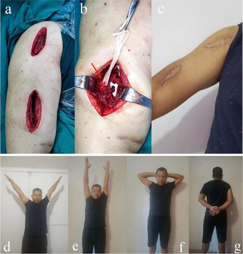 A multi-panel clinical photograph illustrating the surgical approach and functional outcomes of Minimally Invasive Plate Osteosynthesis (MIPO) for a humeral shaft fracture. Panel (a) shows two small, linear surgical incisions on the upper arm, characteristic of a minimally invasive approach. Panel (b) provides an intraoperative view of the distal anterior incision, where the radial nerve is identified and protected (indicated by a red arrow) using surgical retractors and vessel loops to ensure safety during plate insertion. Panel (c) displays the 12-month postoperative appearance of the arm, showing two well-healed, slightly hypopigmented linear scars with smooth texture and minimal inflammation. Panels (d) through (g) demonstrate successful functional recovery of the shoulder and elbow joints, showing the patient performing abduction, flexion, and rotation maneuvers with a full range of motion. This image set serves to educate on the benefits of MIPO in preserving soft tissue integrity, protecting critical neurovascular structures like the radial nerve, and facilitating rapid functional rehabilitation in orthopedic trauma surgery.