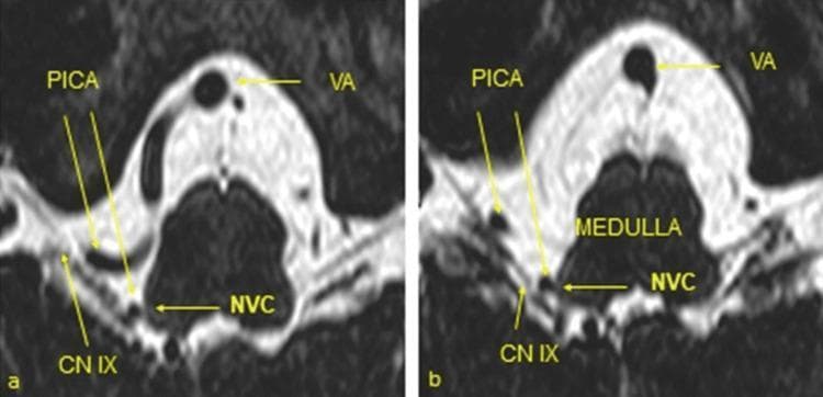 Two high-resolution axial MRI images (a and b) utilizing a heavily T2-weighted CISS (Constructive Interference in Steady State) sequence to demonstrate the neurovascular anatomy of the posterior cranial fossa. The images focus on the ventrolateral medulla oblongata and its associated cranial nerves. Labeled structures include the vertebral artery (VA), the posterior inferior cerebellar artery (PICA), and the glossopharyngeal nerve (CN IX). On the right side, a vascular loop of the PICA is shown in direct contact with the glossopharyngeal nerve at its root entry zone (REZ). This point of contact is labeled as neurovascular compression (NVC), which is the primary pathological finding associated with glossopharyngeal neuralgia. The CISS sequence provides high contrast between the dark (hypointense) vascular and neural structures and the bright (hyperintense) cerebrospinal fluid (CSF), allowing for precise localization of the compression. These images serve as a diagnostic tool for identifying microvascular conflict in patients presenting with cranial nerve syndromes.