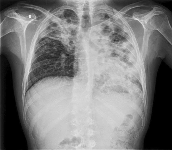 This posteroanterior (PA) chest X-ray demonstrates extensive bilateral pulmonary pathology, highly characteristic of advanced post-primary tuberculosis with superinfection. The left lung field shows a significantly distorted architecture with large, irregular, and oval-shaped lucencies in the upper and middle zones, consistent with pulmonary cavitation. The left lower zone exhibits dense alveolar opacification with visible air bronchograms and spotty shadowing, indicating consolidation. The right lung displays inhomogeneous opacities in the upper and middle lobes, accompanied by volume loss evidenced by the retraction of the right hilum and horizontal fissure. The mediastinal structures appear shifted, and there is visible distortion of the normal hilar anatomy. This diagnostic image illustrates severe parenchymal destruction, cavitary disease, and bilateral infiltrates, which are key clinical markers for evaluating disease severity and treatment response in infectious respiratory medicine.
