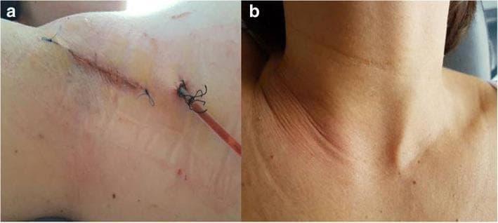 Two-part clinical photograph demonstrating surgical results of a robotic-assisted transaxillary thyroidectomy. Image 'a' provides a close-up of the surgical access point in the axilla at the end of the procedure. It shows a linear, approximately 5 cm incision closed with intermittent sutures. A semi-transparent, reddish surgical drain is visible exiting through a separate stab incision, secured with a purse-string or anchoring suture. Minimal localized erythema is present at the incision margins. Image 'b' shows the anterior neck of the same patient on the first postoperative day. The skin surface is intact with no visible cervical incisions, scars, or significant ecchymosis, highlighting the cosmetic benefit of the remote-access transaxillary approach. Visible landmarks include the suprasternal notch and clavicles. The pair illustrates the concealment of surgical scarring in natural body folds to achieve superior aesthetic outcomes in thyroid surgery.