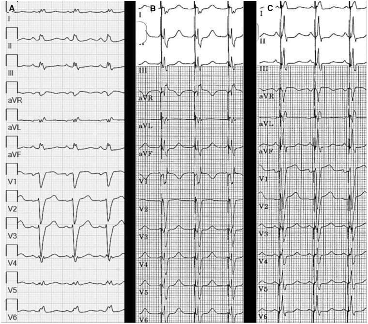 A comparison of three 12-lead electrocardiogram (ECG) strips (labeled A, B, and C) illustrating the effects of Left Bundle Branch Area Pacing (LBBAP) on ventricular activation. Panel A displays baseline sinus rhythm with Left Bundle Branch Block (LBBB), characterized by a wide QRS duration (156 ms), dominant S waves in V1-V3, and broad R waves in I, aVL, and V6. Panel B shows LBBAP with a short Atrioventricular (AV) delay of 40 ms, resulting in a reduced QRS duration of 128 ms and a Right Bundle Branch Block (RBBB) morphology in lead V1 (rSR' pattern), indicating left ventricular capture. Panel C demonstrates the normalization of the QRS complex (120 ms) by increasing the AV delay to 80 ms. This adjustment facilitates physiological fusion between the paced left ventricular activation and intrinsic anterograde conduction through the right bundle. The sequence highlights the transition from wide-complex dyssynchrony to a more narrow, synchronized ventricular activation pattern, with associated improvements in T-wave morphology and ST-segment alignment across the limb and precordial leads.