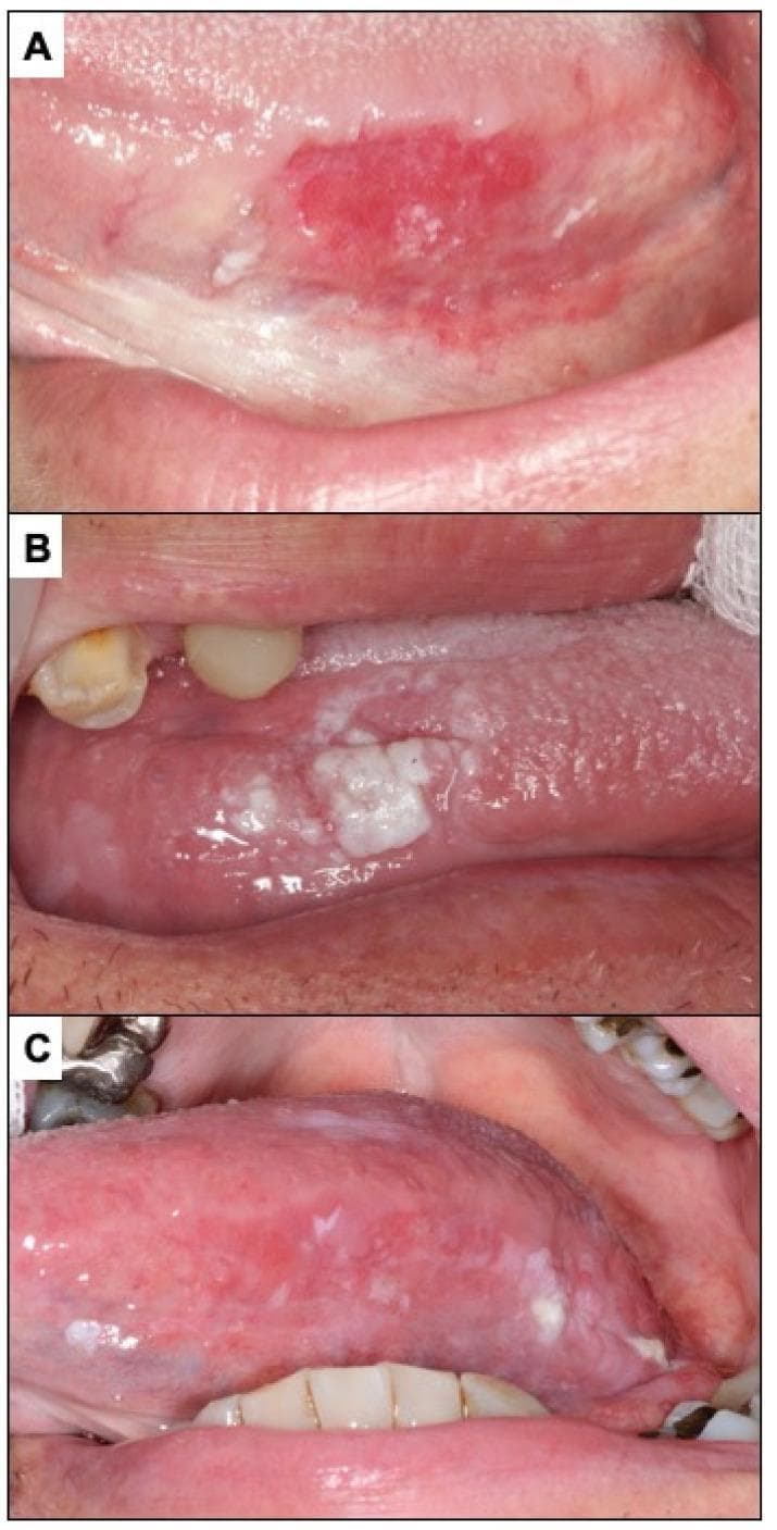 A series of three clinical photographs (A, B, and C) illustrating various clinical presentations of oral potentially malignant disorders and oral squamous cell carcinoma (OSCC) on the lateral border of the tongue.
Panel A displays erythroplasia, appearing as a well-demarcated, fiery red, velvety patch on the lateral tongue surface with focal areas of white stippling.
Panel B shows a leukoplakia-like presentation of oral carcinoma, characterized by thick, non-homogeneous white plaques (leukoplakia) with an irregular, exophytic surface and granular texture on the lateral border.
Panel C demonstrates an advanced oral carcinoma presenting as erythroleukoplakia (speckled leukoplakia). The lesion features a mixed red and white appearance with diffuse erythema, interspersed white patches, and a thickened, granular mucosal texture.
The images are representative of oral oncology and oral pathology, highlighting clinical features such as non-homogeneous color distribution, irregular borders, and surface texture changes that are indicative of malignancy or high-grade dysplasia in oral soft tissues.