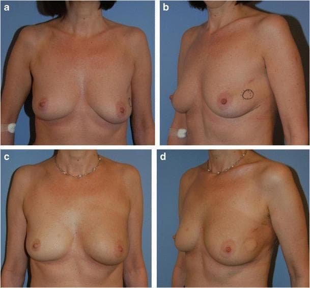 Clinical photographs showing preoperative and postoperative views of a 46-year-old female patient with small breasts and invasive ductal carcinoma (zone VI) in the lateral left breast. Images (a) and (b) provide frontal and oblique preoperative views, illustrating breast hypoplasia with mild ptosis; a surgical marking is visible in the lateral region of the left breast indicating the tumor site. Images (c) and (d) show the three-month postoperative results after breast-conserving surgery (40g lumpectomy) followed by oncoplastic reconstruction. The reconstruction utilized a volume replacement technique via a tunneled lateral thoracodorsal flap with a skin island. The postoperative images demonstrate successful maintenance of breast volume and projection, preservation of the nipple-areola complex (NAC) position, and achievement of good breast symmetry without the need for contralateral surgery. The flap's skin island is visible in the lateral aspect of the left breast in the oblique view (d). These images highlight an effective surgical approach for maintaining aesthetic outcomes in small-breasted patients undergoing oncoplastic breast surgery.