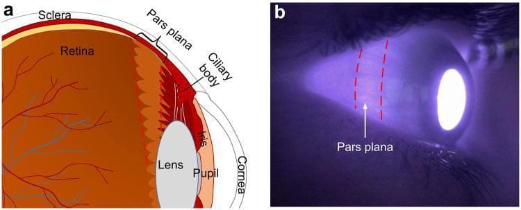 This composite educational graphic details the anatomy and visualization of the pars plana for ophthalmic imaging. (a) An anatomical diagram shows a cross-section of the human eye. The pars plana is identified as the smooth, posterior portion of the ciliary body, located between the retinal ora serrata and the ciliary processes. Key labeled structures include the sclera, retina with vasculature, lens, iris, pupil, and cornea. (b) A clinical photograph displays the eyeball under near-infrared (850 nm) transillumination. The image demonstrates the high transmittance of the pars plana, which appears as a distinctively bright, circumferential band approximately 3–4 mm posterior to the limbus, demarcated by red dashed lines. This educational material illustrates the clinical significance of the pars plana as a strategic anatomical window for trans-scleral illumination in non-mydriatic fundus photography due to its relative lack of muscle, blood vessels, and heavy pigmentation compared to surrounding ocular tissues.