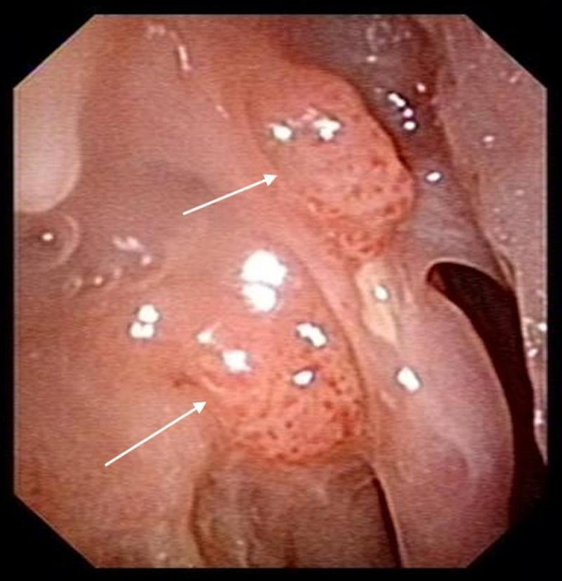 This nasoendoscopy image depicts the right lateral nasal wall, demonstrating a recurrence of an inverted papilloma one year post-operatively. The clinical photograph identifies two primary sites of recurrence, indicated by white arrows. The papillomatous masses exhibit a characteristic exophytic, irregular, and 'cobblestone' surface texture with prominent vascular punctae. These localized lesions are situated along the lateral nasal mucosa, showing a clear morphological transition from the smoother, surrounding healthy mucosal tissue. The endoscopic view provides critical visual evidence for postoperative surveillance in otolaryngology, highlighting the typical growth pattern and morphology of Schneiderian papillomas. The educational focus is on identifying local recurrence and the visual characteristics of sinonasal tumors during diagnostic endoscopy.
