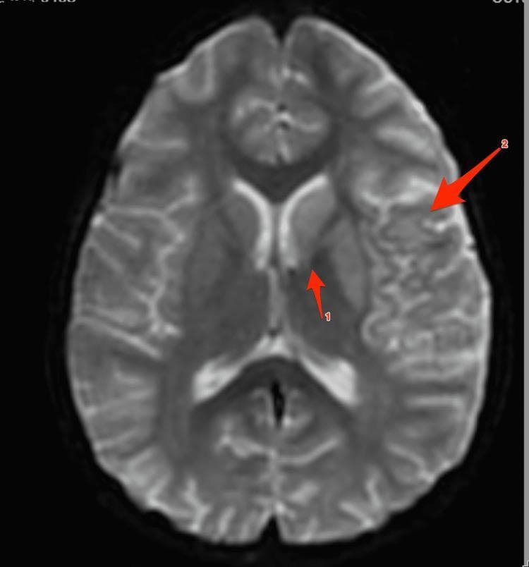 Axial Magnetic Resonance Imaging (MRI) of the brain, specifically a Diffusion-Weighted Imaging (DWI) sequence, demonstrating acute ischemic infarction. Two primary areas of hyperintensity, representing diffusion restriction, are identified with red arrows. Arrow 1 points to a focal area of restricted diffusion in the left caudate nucleus. Arrow 2 highlights a larger, more diffuse area of cortical and subcortical restricted diffusion involving the left parietal and temporal lobes, consistent with an acute infarct within the left middle cerebral artery (MCA) territory. The image exhibits high contrast between the bright, hyperintense pathological regions and the darker, normal brain parenchyma, which reflects normal water diffusion. This diagnostic image is used to educate clinicians on the radiological presentation of acute stroke and the neuroanatomical distribution of ischemic injury in the basal ganglia and cerebral cortex.