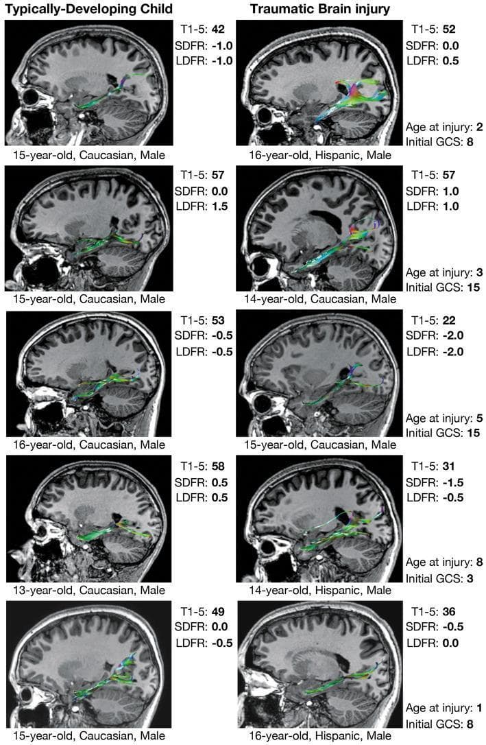 A comparison chart utilizing structural MRI and Diffusion Tensor Imaging (DTI) tractography to visualize the perforant pathway (PP) in pediatric subjects. The image is divided into two columns: Typically-Developing Children (TDC) on the left and children with a history of Traumatic Brain Injury (TBI) on the right. Each panel displays a sagittal T1-weighted brain section overlaid with color-coded white matter streamlines representing the PP, which projects toward the hippocampal formation. Data accompanying each image includes demographics (age, sex, race), injury metrics (age at injury, initial Glasgow Coma Scale score), and verbal memory performance metrics from the California Verbal Learning Test (CVLT), specifically T1-5 trials, short-delay free recall (SDFR), and long-delay free recall (LDFR). The visualization highlights qualitative differences in fiber tract morphology; TBI cases often demonstrate increased streamline density (hypertrophy) or diffused spatial distribution compared to the more compact and uniform tracts in TDC. The educational focus is on neuroplasticity and white matter developmental alterations following pediatric TBI and their correlation with long-term memory outcomes.