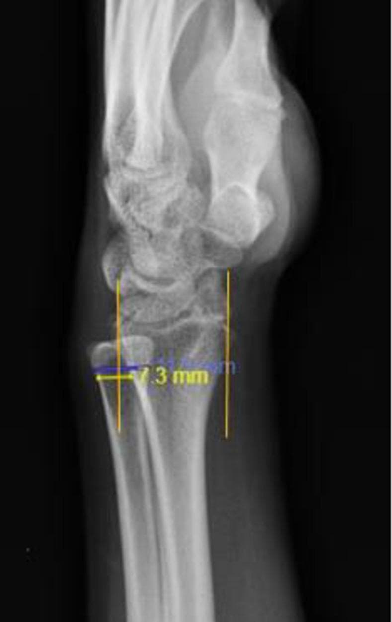This diagnostic image is a lateral radiograph of the wrist and distal forearm demonstrating the radiographic assessment of the distal radioulnar joint (DRUJ) using the Mino method. The image shows the distal radius, distal ulna, and carpal bones in a lateral profile. Two vertical reference lines are drawn parallel to the longitudinal axis of the radius, originating from the volar and dorsal margins of the distal radial articular surface. Overlaid measurements in yellow indicate a quantitative analysis of ulnar head displacement. A specific measurement of 7.3 mm highlights the distance of the dorsal subluxation of the ulnar head relative to the dorsal reference line. According to the Mino criteria, instability or subluxation is diagnosed when more than 25% of the ulnar head width lies outside these boundaries. This visual demonstrates dorsal DRUJ subluxation, a significant finding in cases of wrist trauma or ligamentous instability, typically used by orthopedic and radiology professionals to evaluate joint congruity.