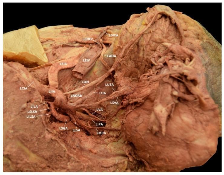This clinical photograph of a gross anatomical dissection showcases the intricate vascular anatomy of the left female pelvis, with a focus on variations of the obturator artery. The image depicts the left common iliac artery (LCIA) bifurcating into the external (LEIA) and internal (LIIA) iliac arteries. The LIIA is shown branching into its posterior and anterior divisions. Notable posterior branches include the iliolumbar (LILA), superior lateral sacral (LSLSA), inferior lateral sacral (LILSA), and superior gluteal (LSGA) arteries. Anterior division branches visible include the umbilical (LUA), uterine (LUTA), superior vesical (LSVA), vaginal (LVA), middle rectal (LMRA), and internal pudendal (LIPA) arteries. A significant anatomical variation is highlighted: a left aberrant obturator artery (LAOA) originating from the left deep inferior epigastric artery (LDIEA), rather than the internal iliac system. Additionally, a left accessory obturator artery branch (LAOAB) is seen arising from the posterior division of the LIIA. The spatial relationship of these vessels to the left external iliac vein (LEIV) and left obturator nerve (LON) is clearly labeled.