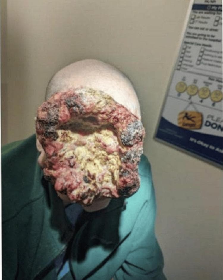 This clinical photograph displays a massive, locally advanced malignant tumor, identified contextually as squamous cell carcinoma, involving the right facial and frontal scalp regions. The lesion is characterized by prominently raised, exophytic, 'cauliflower-like' margins with a highly irregular and verrucous texture. The center of the mass is deeply depressed and exhibits extensive yellow-white slough and purulent-appearing material consistent with significant tissue necrosis. Throughout the lesion, there are variegated colors including erythematous pink areas of friable tissue and dark, blackened crusting or scabbing indicative of chronic capillary bleeding and hemorrhage. The mass is large enough to cause complete mechanical obstruction of the right ocular region and severe periorbital edema. This image serves as a significant example of dermatologic oncology, illustrating disease progression in a patient with limited access to care and the clinical presentation of a fungating facial malignancy with intracranial extension.