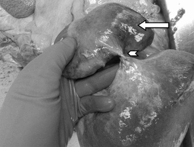 This grayscale clinical photograph captures a post-mortem specimen of a gallbladder volvulus. The image shows a grossly distended and necrotic gallbladder (indicated by the white arrow) that has undergone torsion. A clear fulcrum point or twist (marked by the white arrowhead) is visible at the neck of the organ, involving the vascular pedicle and cystic duct. The distal gallbladder body and fundus exhibit significant darkening and discoloration consistent with gangrenous changes and tissue necrosis resulting from vascular compromise. A gloved hand is positioned to retract the organ, highlighting its abnormal mobility and the specific site of the twist. This image serves as a pathological example of gallbladder torsion, a rare but life-threatening surgical emergency, typically associated with a long, mobile mesentery or 'floating gallbladder' anatomy. The visual evidence of hemorrhagic necrosis and severe distension illustrates the end-stage result of prolonged ischemia following mechanical torsion.