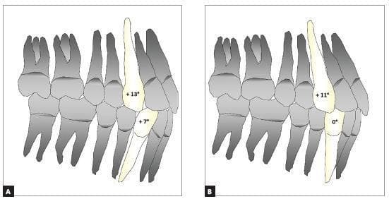 Comparison Chart of dental anatomy and biomechanics illustrating the impact of canine angulation on the dental arch perimeter and incisor positioning in orthodontic prescriptions. The image presents two side-by-side anatomical diagrams, labeled A and B, showing a lateral view of the maxillary and mandibular dentition including incisors, canines, premolars, and molars. In Diagram A (representing a Roth prescription), the maxillary canine is highlighted with a +13° mesial angulation and the mandibular canine with +7°, resulting in increased proclination of the central incisors. In Diagram B (representing Class III compensated brackets), the maxillary canine shows a reduced angulation of +11° while the mandibular canine is vertical at 0°, demonstrating dental compensation that facilitates torque adjustments and decreases incisor inclination. The educational focus is on how specific tooth angulations (tip) influence arch perimeter and aesthetic or functional outcomes in orthodontic treatment planning for different malocclusion classifications.