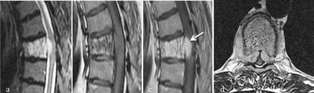 This composite diagnostic image features four MRI views of the thoracic spine illustrating an aggressive hemangioma at the T6 vertebral level. (a) Sagittal T2-weighted image shows high signal intensity within the vertebral body, indicating hypervascularity or edema. (b) Sagittal T1-weighted image shows a corresponding area of intermediate signal. (c) Post-contrast sagittal T1-weighted image demonstrates intense enhancement of the vertebral body with clear extension into the anterior epidural space (arrow) and anterior soft tissues (arrowhead), causing narrowing of the spinal canal. (d) Axial T1-weighted post-contrast image confirms circumferential involvement of the T6 vertebral body and bilateral soft tissue extension into the epidural space, resulting in mild cord compression. The presence of extra-osseous extension and cortical breakthrough characterizes this as an aggressive variant of a vertebral hemangioma, a key differentiator from typical latent hemangiomas. These features are critical for diagnosing potential spinal cord compression in the context of musculoskeletal oncology and neuroradiology.