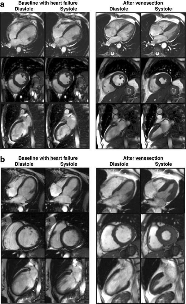This diagnostic image display consists of two panels (a and b) showing Cardiac Magnetic Resonance (CMR) scans of two different patients with C282Y homozygous hereditary hemochromatosis. Each panel provides a comparison between 'Baseline with heart failure' and 'After venesection' states, captured during both end-diastole and end-systole. The CMR views include the horizontal long axis (top row), mid-ventricular short axis (middle row), and vertical long axis (bottom row).
At baseline, the images demonstrate features of dilated cardiomyopathy: a globally enlarged, more spherical left ventricle (LV) with thinned myocardial walls and significantly reduced systolic wall thickening, correlating with a low Left Ventricular Ejection Fraction (LVEF). Post-venesection images show marked clinical improvement, characterized by a reduction in LV chamber size, more conical ventricular morphology, and increased myocardial wall thickening during systole, indicating recovered LVEF. The scans illustrate the reversibility of iron-overload induced cardiac dysfunction through iron removal therapy (venesection), providing a visual representation of improved myocardial T2* values and ventricular remodeling.