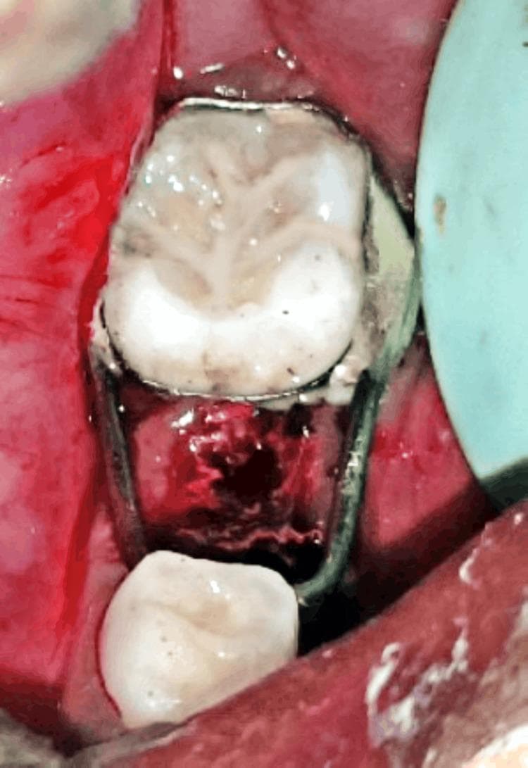This intraoral clinical photograph demonstrates the immediate post-operative placement of a fixed band and loop space maintainer in a pediatric patient. The appliance is anchored on a primary molar, likely the mandibular second deciduous molar, which shows significant occlusal wear and staining. A stainless steel band is closely adapted around the tooth's circumference, secured with visible luting glass ionomer cement at the margins. Soldered to the band is a passive metal wire loop that extends anteriorly across an edentulous space created by a recent extraction. The loop is contoured to contact the distal surface of the adjacent tooth, preventing the mesial drifting of the posterior molar and preserving arch length for permanent tooth eruption. The extraction site shows a fresh blood clot within the socket. The surrounding gingival tissues exhibit moderate postoperative erythema and inflammation. This image illustrates a standard preventive orthodontic intervention in pediatric dentistry to manage premature loss of primary teeth.