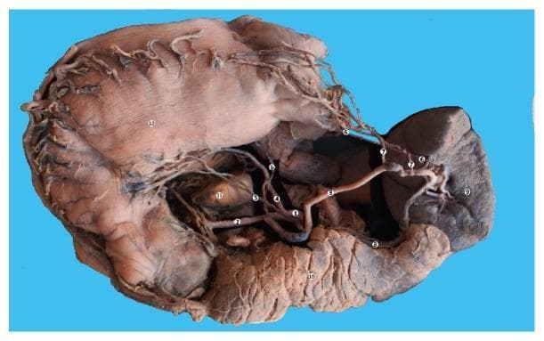 This clinical photograph displays a gross macrospecimen dissection of the upper abdominal viscera from a 63-year-old female, highlighting the celiac trunk (1) and its vascular branches. The central celiac trunk is shown giving rise to the left gastric artery (4) ascending toward the lesser curvature of the stomach (12), the common hepatic artery (2) coursing toward the caudate lobe of the liver (11), and the splenic artery (3) traveling toward the spleen (9). Notable anatomical variations include an accessory left gastric artery (5) and posterior gastric arteries (6) originating from the splenic artery. The splenic vein (8) is visible running inferior to the splenic artery. The pancreas (10) is situated inferior to the splenic vessels, demonstrating its lobulated texture. This image serves as a detailed anatomical reference for the trifurcation of the celiac trunk, the vascular supply to the foregut organs (stomach, spleen, liver, pancreas), and common arterial variations relevant to surgical oncology and gastroenterology training.