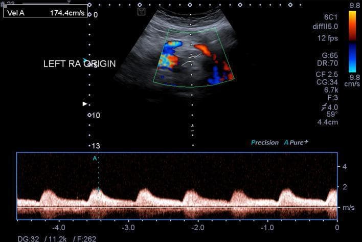 This diagnostic image is a duplex ultrasound combining color Doppler and spectral pulse wave Doppler of the abdominal aorta at the level of the left renal artery (RA) origin. The upper panel displays a color Doppler image showing a mosaic pattern of red, blue, and yellow hues within the vessel, indicating turbulent flow and aliasing. The lower panel displays a spectral waveform characterized by a 'tardus parvus' morphology. This pattern is defined by a delayed systolic upstroke (prolonged acceleration time) and low-amplitude, rounded peaks with a decreased peak systolic velocity (PSV), here measured at approximately 174.4 cm/s. Such hemodynamic findings are clinically significant as they typically occur distal to a high-grade arterial stenosis or obstruction, representing the dampening of the pulse wave as it passes through a narrowed segment of the aorta. This educational visual is essential for understanding vascular hemodynamics and the diagnostic criteria for aortic or renal artery pathology in radiology and vascular medicine.