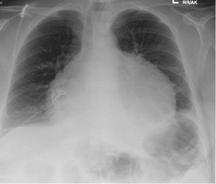 This diagnostic image is an anteroposterior (AP) chest X-ray demonstrating significant cardiomegaly. The cardiac silhouette is markedly enlarged with a global, rounded appearance, commonly referred to as a 'water bottle' heart, which is characteristic of a large pericardial effusion. Lung field analysis reveals cephalization of the pulmonary vessels (upper lobe blood diversion), suggesting pulmonary venous congestion. Bilateral blunting of the costophrenic angles is present, consistent with small pleural effusions. Subtle opacities are noted at the right lung base and in the region of the lingula, possibly representing atelectasis or early pulmonary edema. These radiographic findings are highly suggestive of congestive heart failure or a large pericardial effusion progressing toward cardiac tamponade. The image serves as a clinical teaching tool for identifying markers of left heart failure and pathological enlargement of the mediastinal silhouette in an emergency or critical care context.