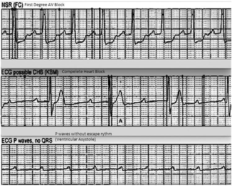 This diagnostic image displays a vertical comparison of three ECG rhythm strips demonstrating the progression and characteristics of different cardiac conduction abnormalities. The top strip, labeled 'NSR (FC) First Degree AV Block,' shows a sinus rhythm with a prolonged PR interval, indicating a delay in conduction between the atria and ventricles. The middle strip, labeled 'ECG possible CHB (KBM) Complete Heart Block,' illustrates third-degree atrioventricular (AV) block characterized by complete AV dissociation; P waves are present but occur independently of the slow, irregular QRS complexes (escape rhythm). The bottom strip, labeled 'ECG P waves, no QRS (Ventricular Asystole),' depicts a high-grade block where atrial activity (P waves) continues, but there is a total failure of ventricular conduction resulting in ventricular asystole. This sequence serves as an educational tool for identifying varying severity levels of heart blocks and the transition from conduction delay to lethal ventricular standstill.