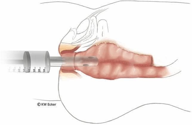 Anatomical diagram in longitudinal section depicting a surgical bubble test following an ileal pouch-anal anastomosis (IPAA). The illustration shows a soft ileostomy catheter inserted transanally through the anal canal and internal/external sphincter complex into the distal aspect of an ileal J-pouch. The catheter tip features multiple side-perforations to facilitate air insufflation. A large-volume syringe (approximately 70 ml capacity, with the plunger positioned near the 40-50 ml mark) is attached to the external end of the catheter. The visual highlights the relationship between the newly constructed anastomosis line and the transanal instrumentation. This diagnostic maneuver is used intraoperatively to identify potential anastomotic leaks by observing for air bubbles in a saline-filled pelvis. The diagram emphasizes key structures including the rectal cuff, the pouch-anal junction, and the surrounding pelvic floor anatomy in the context of colorectal surgery and fecal diversion management.