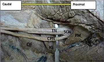 This clinical photograph displays a detailed cadaveric dissection of the right human gluteal region and posterior thigh, focusing on an anatomical variation of the sciatic nerve. The image illustrates a 'high bifurcation' of the sciatic nerve (SCN), where it divides into its terminal branches approximately 1 cm inferior to the lower border of the piriformis muscle (PM) rather than in the popliteal fossa. The two resulting divisions—the tibial nerve (TN) and the common peroneal nerve (CPN)—are clearly identified. Surrounding musculoskeletal landmarks include the quadratus femoris (QF) located inferiorly and the inferior gemellus (IG) muscle situated deep to the bifurcation point. Labels indicate the 'Caudal' and 'Proximal' orientations. This specimen serves as an educational resource for studying peripheral nerve anatomy and surgical variations in the gluteal region, which is clinically significant for procedures like piriformis syndrome decompression or sciatic nerve blocks.