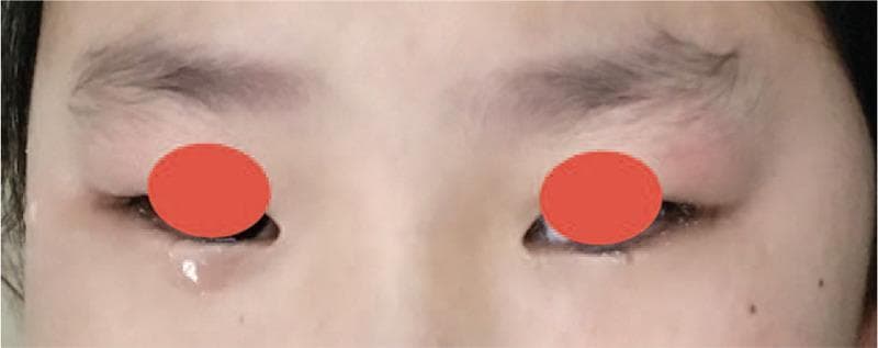 This clinical photograph displays a close-up frontal view of a pediatric patient's orbital region, demonstrating asymmetric epiphora (excessive tearing). The primary finding is a prominent tear drop and fluid pooling along the lower eyelid margin of the right eye, contrasting with the left eye, which shows minimal tear production. The facial skin is fair with a few scattered benign-appearing pigmented macules (freckles). Both eyes are partially obscured by red circles for privacy. This visual represents a clinical manifestation of unilateral nasolacrimal duct obstruction, often caused in pediatric cases by anatomical abnormalities such as a dentigerous cyst or ectopic tooth impinging on the lacrimal drainage system. The image highlights the objective difference in tear shedding (lacrimation) between a healthy eye and one with drainage impairment, serving as a diagnostic indicator for maxillofacial or ophthalmologic pathology.