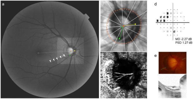 This composite diagnostic image illustrates an ophthalmic evaluation of an eye with a glaucoma-related initial nasal step (INS). Panel (a) is a red-free fundus photograph identifying key landmarks: the Bruch's membrane opening (BMO, red dots), central retinal vascular trunk (CRVT, yellow dot), and a retinal nerve fiber layer defect (RNFLD, white arrowheads) with its proximal margin marked (green dot). Panel (b) shows an infrared OCT image with a best-fitted ellipse for the BMO (orange) and geometric measurements relative to the fovea-BMO axis (white dotted line), including CRVT obliqueness (red angle) and RNFLD proximity (green angle). Panel (c) is an en face OCT angiography (OCTA) image of the choroidal layer, which demonstrates an intact microvascular network without focal dropout. Panel (d) displays Humphrey visual field results with a mean deviation of -2.27 dB, confirming a nasal step defect. Panel (e) includes a color disc photograph and a corresponding B-scan OCT image of the optic nerve head, showing no focal lamina cribrosa defects. This set demonstrates the spatial relationship between optic disc anatomy, vascular exit points, and functional visual field loss.