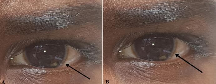This clinical photograph consists of two panels (A and B) showing the right and left eyes of a patient with dark-pigmented skin. The primary pathological finding is a Kayser-Fleischer ring, visible as a distinct brownish-golden or greenish-brown discoloration at the periphery of the cornea near the limbus. The ring is most prominent in the superior and inferior poles, appearing as a circumferential band that encircles the dark brown iris. The sclera shows mild conjunctival vascularity but is otherwise white. The pupils are round and reactive to light. This ocular sign is a hallmark clinical manifestation of Wilson disease, resulting from copper deposition in Descemet's membrane. The image serves as a classic educational example for hepatology, neurology, and ophthalmology, illustrating the diagnostic physical exam findings associated with impaired copper metabolism.