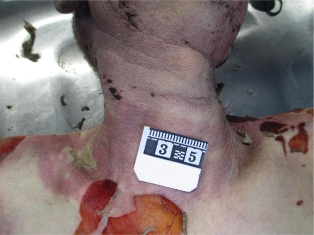 This forensic clinical photograph depicts the anterior neck and upper torso of a deceased individual, illustrating key post-mortem findings. A distinct, horizontally oriented ligature mark is visible across the mid-to-lower neck, characterized by a purplish, indented furrow indicating antemortem or perimortem constriction. The mark is described as 'open,' suggesting it does not fully encircle the neck without interruption. Surrounding the neck and extending onto the chest and shoulders are significant thermal injuries. These are characterized by patchy areas of erythema and extensive epidermal slippage (skin peeling) with yellowish to reddish-brown underlying dermis, consistent with post-mortem burn changes. Scattered dark punctate lesions and debris are also noted on the neck surface. A forensic scale is placed on the lower neck for measurement. The image serves as an educational resource for forensic pathology, demonstrating the visual differentiation between ligature strangulation marks and thermal artifacts on a cadaver.