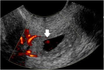 Transvaginal ultrasound (TVUS) with color Doppler demonstrating a cervical ectopic pregnancy. The image shows a well-defined, fluid-filled gestational sac located within the distended cervical canal, below the level of the internal os. Color Doppler imaging reveals prominent circumferential peripheral flow (the 'ring of fire' sign), indicating peritrophoblastic vascularization. A white arrow points to an internal focal Doppler signal within the gestational sac, representing blood flow associated with the developing embryo. This finding is critical for distinguishing a live cervical ectopic pregnancy from a spontaneous abortion in progress (miscarriage), where the gestational sac might be found in a similar cervical position but would lack active peritrophoblastic and internal embryonic vascularity.