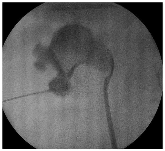 This diagnostic fluoroscopic image captures a percutaneous nephrolithotomy (PCNL) procedure. The image displays the renal collecting system opacified by contrast medium, highlighting the anatomy of the renal pelvis and several minor and major calyces. A radiopaque kidney stone (urolithiasis) is clearly visible within one of the lower pole calyces. A thin, linear hydrophilic guidewire is seen entering the kidney through a percutaneous access tract, directed toward the target calyx containing the stone. The image demonstrates the critical intraoperative step of achieving and maintaining percutaneous access to the intrarenal collecting system under fluoroscopic guidance. This material is pedagogically relevant for urology trainees and medical students to understand the radiological appearance of the pyelocaliceal system during minimally invasive surgical interventions for renal calculi.