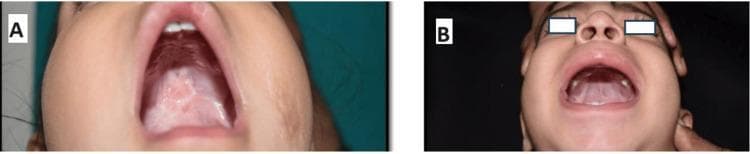 This clinical photograph exhibits a side-by-side comparison of postoperative outcomes 3 months after cleft palate repair in pediatric patients. Image A displays the results of a Furlowβs Z-plasty; the hard and soft palate show a well-integrated repair with a characteristic Z-shaped scar pattern. The tissue appears whitish-pink, indicative of healthy scarring and mucosal maturation, with no evidence of oronasal fistula. Image B demonstrates the outcome of a straight-line intravelar veloplasty (Von Langenbeck technique). The palate exhibits a linear midline scar extending toward the soft palate. The mucosa is pink and vascularized, with no visible dehiscence or residual defects. Both images serve as educational examples of palatoplasty techniques in oral and maxillofacial surgery, illustrating the aesthetic and structural restoration of the palatal vault and the absence of common complications like fistulas at the 3-month follow-up milestone.