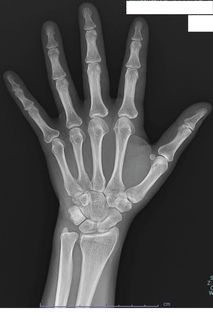A posterior-anterior (PA) diagnostic X-ray of the left hand. The imaging demonstrates the distal radius and ulna, carpal bones, metacarpals, and phalanges in normal anatomical alignment. The joint spaces, including the radiocarpal, intercarpal, metacarpophalangeal (MCP), and proximal/distal interphalangeal (PIP/DIP) joints, appear well-preserved with no evidence of joint space narrowing, erosions, or subchondral sclerosis. The bone mineralization and cortical thickness are within normal limits. There are no periarticular osteopenia, marginal erosions, or joint deformities, such as ulnar drift or boutonnière deformity, which are typical of advanced rheumatoid arthritis. The surrounding soft tissues are unremarkable with no signs of swelling or calcification. This image serves as a baseline comparison for inflammatory arthropathies or to rule out structural bone disease in patients presenting with arthralgia or morning stiffness.