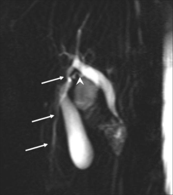 This diagnostic image is a Magnetic Resonance Cholangiopancreatography (MRCP) projection showing the anatomy of the biliary tree and gallbladder. The image highlights a significant anatomical variation involving an accessory liver lobe. Multiple white arrows point to an accessory bile duct that originates from the ectopic hepatic tissue and drains directly into the common hepatic duct. Additionally, a white arrowhead indicates a separate, tortuous cystic duct that follows an atypical path before opening into the primary bile duct. The gallbladder is visualized as a hyperintense, elongated structure of normal morphology. This clinical image is significant for demonstrating complex biliary branching patterns often associated with accessory liver lobes, which is critical for surgical planning to avoid iatrogenic injury. The educational focus is on hepatobiliary anatomy, congenital variants, and radiological interpretation of MRCP in the context of suspected accessory hepatic tissue.