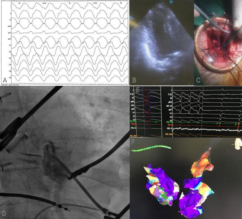 This composite figure illustrates a multidisciplinary approach to managing ventricular tachycardia (VT) via transapical access. Panel A presents a 12-lead electrocardiogram (ECG) tracing showing a wide-complex tachycardia consistent with VT. Panel B is a transthoracic echocardiogram demonstrating an aneurysmal left ventricular (LV) apex. Panel C provides a clinical photograph of a surgical transapical incision in the left thorax, showing stay sutures and surgical instruments utilized for sheath insertion. Panel D displays a fluoroscopic image showing the placement of an ablation catheter within the LV cavity, positioned to avoid contact with metallic prosthetic valves. Panel E contains electrophysiology study (EPS) tracings, including surface leads and intracardiac electrograms (RV-D and ABL-D), showing the termination of VT during radiofrequency (RF) ablation. Panel F exhibits a 3D electroanatomical voltage map of the LV aneurysm and epicardium; purple areas indicate low-voltage scar tissue, while color-coded points signify ablation sites. This collection highlights the integration of cardiac imaging, surgery, and electrophysiology for complex arrhythmia management.