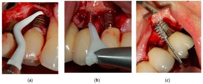 This composite of three clinical intraoral photographs (a, b, and c) demonstrates different mechanical debridement techniques for the surgical treatment of peri-implantitis. Each image shows an exposed dental implant within an osseous defect following the elevation of a full-thickness mucoperiosteal flap. In image (a), a white, curved plastic Gracey-type curette is used to manually scale the implant surface to remove biofilm and granulation tissue. Image (b) shows the use of a Perio-Flow® air-polishing device, featuring a flexible white nozzle designed to deliver glycine powder under pressure for non-contact surface decontamination. Image (c) illustrates a Ti-Brush® consisting of a stainless steel shaft with titanium bristles, which is used for mechanical scrubbing and polishing of the implant threads. The images highlight the variations in instrument morphology—from manual scraping tools to pressurized air nozzles and rotating brushes—used in regenerative or resective periodontal surgery to manage peri-implant bone loss.