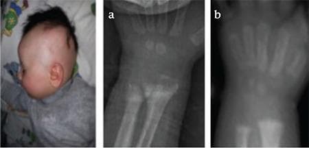 This composite figure presents clinical and radiological findings in a pediatric patient with Hereditary Vitamin D-Resistant Rickets (HVDRR). The left panel is a clinical photograph of an infant showing near-total alopecia, a hallmark feature of certain VDR gene mutations. Panels (a) and (b) are diagnostic radiographs of the wrist and distal forearm. Radiograph (a) demonstrates classic baseline rachitic changes, including significant cupping, fraying, and widening of the distal radial and ulnar metaphyses, alongside generalized osteopenia and an obscured provisional zone of calcification. Radiograph (b) shows the same anatomical region following medical management with high-dose calcitriol, calcium, and cinacalcet. This follow-up image exhibits marked interval improvement, characterized by increased bone density (remineralization) and a significant reduction in metaphyseal fraying and cupping, indicating partial healing of the skeletal rickets. The series serves as an educational comparison of disease manifestation and therapeutic response in metabolic bone disease.