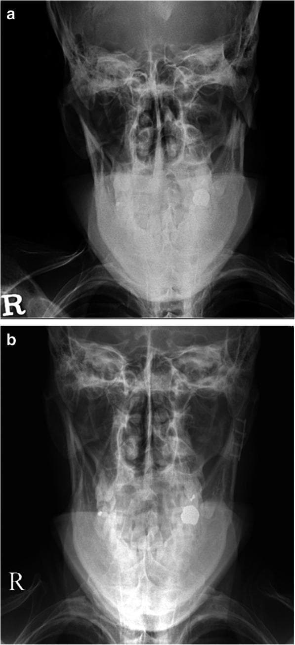 This figure presents two radiographic images in a modified Towne’s projection (frontal view with caudal angulation) of a 40-year-old male patient, demonstrating a comparison between a pre-operative subcondylar fracture and its post-operative state.
Image 'a' (top) shows a left-sided subcondylar mandibular fracture with significant medial deviation and displacement of the condylar fragment relative to the mandibular ramus. Discontinuity of the bony cortex is evident at the fracture site.
Image 'b' (bottom) illustrates the post-operative result following Open Reduction and Internal Fixation (ORIF). The mandibular condyle has been realigned to its proper anatomical position within the glenoid fossa. Rigid internal fixation is visible, consisting of a radiopaque metallic plate and screws secured along the lateral aspect of the mandibular ramus and subcondylar region.
Both images clearly depict standard landmarks for a Towne’s view, including the occipital bone, foramen magnum, and the relationship of the mandibular condyles to the zygomatic arches. These images serve as an educational example of maxillofacial trauma management and the efficacy of rigid internal fixation in restoring anatomical alignment.