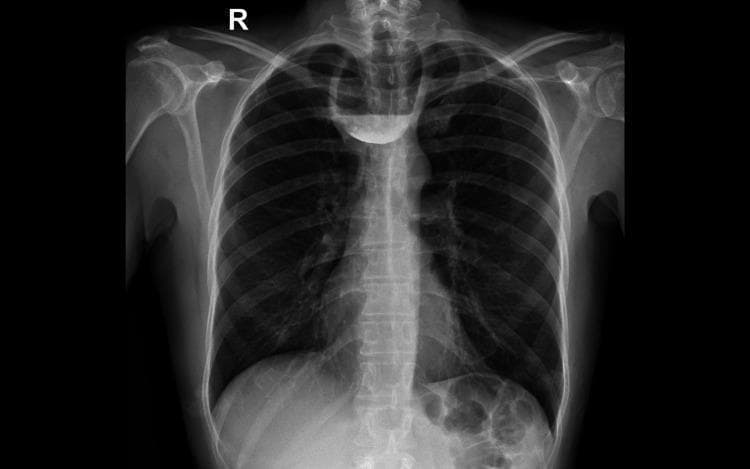 This anteroposterior (AP) barium swallow radiograph of the chest and upper abdomen demonstrates a prominent Zenker's diverticulum. The primary finding is a large, pouch-like radiopaque structure located in the superior mediastinum, superimposed on the upper thoracic vertebrae and positioned just above the level of the clavicles. The diverticulum exhibits a distinct air-fluid level, with the inferior portion filled with dense barium contrast and the superior portion containing air. The trachea remains midline, although the large size of the diverticulum may cause minor posterior or lateral displacement not fully appreciated in the AP view. The lung fields appear clear without evidence of active consolidation, and the skeletal structures, including the ribs and clavicles, are unremarkable. This diagnostic image is characteristic of a pharyngoesophageal diverticulum, typically occurring through Killian's dehiscence, and is a key educational example for gastrointestinal radiology and the evaluation of chronic dysphagia.