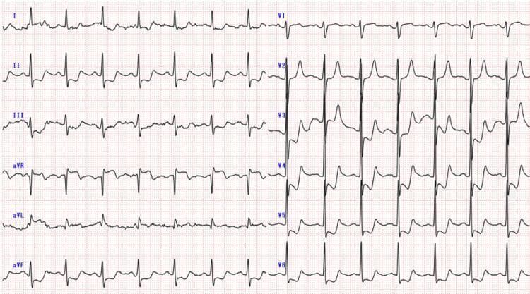 This diagnostic image is a 12-lead electrocardiogram (ECG) demonstrating signs of global subendocardial ischemia. The tracing shows a normal sinus rhythm with a heart rate of approximately 75 beats per minute. Significant visual findings include widespread horizontal or downsloping ST-segment depressions observed in the inferior leads (II, III, aVF), lateral leads (I, aVL), and the precordial leads (V2 through V6). Accompanying these findings is a prominent ST-segment elevation in lead aVR. This specific pattern—diffuse ST-segment depression with reciprocal ST elevation in lead aVR—is a critical clinical indicator often associated with left main coronary artery occlusion, triple-vessel disease, or severe global myocardial oxygen supply-demand mismatch, such as that seen in Stanford Type A aortic dissection involving the coronary ostia. The QRS complexes appear to have normal duration and morphology without evidence of pathological Q waves.