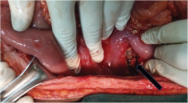This clinical photograph shows an intraoperative view during an exploratory laparotomy, illustrating severe abdominal pathology. The image reveals loops of small and large intestines with significant inflammation. Key pathological findings include mesenteric fat saponification, visible as characteristic opaque, whitish, chalky deposits scattered across the normally yellow fatty tissue of the mesentery and omentum, indicative of enzymatic fat necrosis. A black arrow points toward the pancreatic region, which shows evidence of a necrotic transection at the junction of the body and neck, marked by darkened, devitalized tissue and loss of structural integrity. Hemorrhagic fluid is visible in the dependent portions of the peritoneal cavity. The image serves as a teaching tool for recognizing the gross appearance of acute necrotizing pancreatitis and its associated mesenteric complications in a surgical setting. The context indicates a Grade III isolated pancreatic injury with substantial hemoperitoneum.